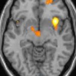 Can trazodone trigger migraine?